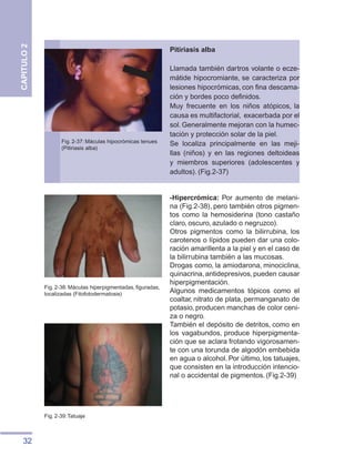 32
CAPITULO
2
Pitiriasis alba
Llamada también dartros volante o ecze-
mátide hipocromiante, se caracteriza por
lesiones hipocrómicas, con fina descama-
ción y bordes poco definidos.
Muy frecuente en los niños atópicos, la
causa es multifactorial, exacerbada por el
sol. Generalmente mejoran con la humec-
tación y protección solar de la piel.
Se localiza principalmente en las meji-
llas (niños) y en las regiones deltoideas
y miembros superiores (adolescentes y
adultos). (Fig.2-37)
Fig. 2-37: Máculas hipocrómicas tenues
(Pitiriasis alba)
Fig. 2-38: Máculas hiperpigmentadas, figuradas,
localizadas (Fitofotodermatosis)
Fig. 2-39:Tatuaje
-Hipercrómica: Por aumento de melani-
na (Fig.2-38), pero también otros pigmen-
tos como la hemosiderina (tono castaño
claro, oscuro, azulado o negruzco).
Otros pigmentos como la bilirrubina, los
carotenos o lípidos pueden dar una colo-
ración amarillenta a la piel y en el caso de
la bilirrubina también a las mucosas.
Drogas como, la amiodarona, minociclina,
quinacrina,antidepresivos,pueden causar
hiperpigmentación.
Algunos medicamentos tópicos como el
coaltar, nitrato de plata, permanganato de
potasio, producen manchas de color ceni-
za o negro.
También el depósito de detritos, como en
los vagabundos, produce hiperpigmenta-
ción que se aclara frotando vigorosamen-
te con una torunda de algodón embebida
en agua o alcohol. Por último, los tatuajes,
que consisten en la introducción intencio-
nal o accidental de pigmentos. (Fig.2-39)
 