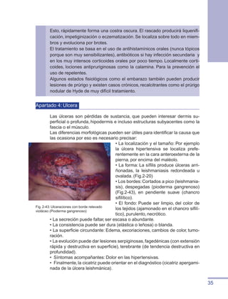 35
Esto, rápidamente forma una costra oscura. El rascado producirá liquenifi-
cación, impetiginización o eczematización. Se localiza sobre todo en miem-
bros y evoluciona por brotes.
El tratamiento se basa en el uso de antihistamínicos orales (nunca tópicos
porque son muy sensibilizantes), antibióticos si hay infección secundaria y
en los muy intensos corticoides orales por poco tiempo. Localmente corti-
coides, lociones antipruriginosas como la calamina. Para la prevención el
uso de repelentes.
Algunos estados fisiológicos como el embarazo también pueden producir
lesiones de prúrigo y existen casos crónicos, recalcitrantes como el prúrigo
nodular de Hyde de muy difícil tratamiento.
Apartado 4: Ulcera
Las úlceras son pérdidas de sustancia, que pueden interesar dermis su-
perficial o profunda, hipodermis e incluso estructuras subyacentes como la
fascia o el músculo.
Las diferencias morfológicas pueden ser útiles para identificar la causa que
las ocasiona por eso es necesario precisar:
• La localización y el tamaño: Por ejemplo
la úlcera hipertensiva se localiza prefe-
rentemente en la cara anteroexterna de la
pierna, por encima del maléolo.
• La forma: La sífilis produce úlceras arri-
ñonadas, la leishmaniasis redondeada u
ovalada. (Fig.2-20)
• Los bordes:Cortados a pico (leishmania-
sis), despegadas (pioderma gangrenoso)
(Fig.2-43), en pendiente suave (chancro
sifilítico).
• El fondo: Puede ser limpio, del color de
los tejidos (ajamonado en el chancro sifilí-
tico), purulento, necrótico.
• La secreción puede faltar, ser escasa o abundante.
• La consistencia puede ser dura (elástica o leñosa) o blanda.
• La superficie circundante: Edema, excoriaciones, cambios de color, tumo-
ración.
• La evolución puede dar lesiones serpiginosas,fagedénicas (con extensión
rápida y destructiva en superficie), terebrante (de tendencia destructiva en
profundidad).
•	 Síntomas acompañantes: Dolor en las hipertensivas.
•	 Finalmente,la cicatriz puede orientar en el diagnóstico (cicatriz apergami-
nada de la úlcera leishmánica).
Fig. 2-43: Ulceraciones con borde relevado
violáceo (Pioderma gangrenoso)
 