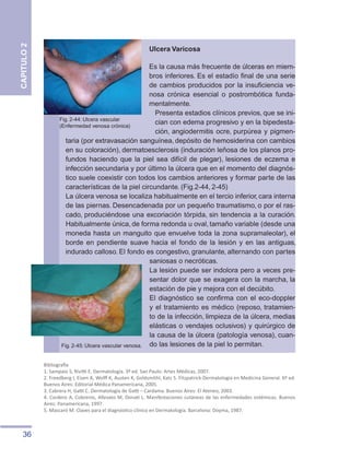 36
CAPITULO
2
Ulcera Varicosa
Es la causa más frecuente de úlceras en miem-
bros inferiores. Es el estadío final de una serie
de cambios producidos por la insuficiencia ve-
nosa crónica esencial o postrombótica funda-
mentalmente.
Presenta estadios clínicos previos, que se ini-
cian con edema progresivo y en la bipedesta-
ción, angiodermitis ocre, purpúrea y pigmen-
taria (por extravasación sanguínea, depósito de hemosiderina con cambios
en su coloración), dermatoesclerosis (induración leñosa de los planos pro-
fundos haciendo que la piel sea difícil de plegar), lesiones de eczema e
infección secundaria y por último la úlcera que en el momento del diagnós-
tico suele coexistir con todos los cambios anteriores y formar parte de las
características de la piel circundante. (Fig.2-44, 2-45)
La úlcera venosa se localiza habitualmente en el tercio inferior, cara interna
de las piernas. Desencadenada por un pequeño traumatismo, o por el ras-
cado, produciéndose una excoriación tórpida, sin tendencia a la curación.
Habitualmente única, de forma redonda u oval, tamaño variable (desde una
moneda hasta un manguito que envuelve toda la zona supramaleolar), el
borde en pendiente suave hacia el fondo de la lesión y en las antiguas,
indurado calloso. El fondo es congestivo, granulante, alternando con partes
saniosas o necróticas.
La lesión puede ser indolora pero a veces pre-
sentar dolor que se exagera con la marcha, la
estación de pie y mejora con el decúbito.
El diagnóstico se confirma con el eco-doppler
y el tratamiento es médico (reposo, tratamien-
to de la infección, limpieza de la úlcera, medias
elásticas o vendajes oclusivos) y quirúrgico de
la causa de la úlcera (patología venosa), cuan-
do las lesiones de la piel lo permitan.
Fig. 2-44: Ulcera vascular
(Enfermedad venosa crónica)
Bibliografía
1. Sampaio S, Rivitti E. Dermatología. 3ª ed. Sao Paulo: Artes Médicas, 2007.
2. Freedberg I, Eisen A, Wolff K, Austen K, Goldsmithl, Katz S. Fitzpatrick-Dermatología en Medicina General. 6ª ed.
Buenos Aires: Editorial Médica Panamericana, 2005.
3. Cabrera H, Gatti C. Dermatología de Gatti – Cardama. Buenos Aires: El Ateneo, 2003.
4. Cordero A, Cobreros, Allevato M, Donati L. Manifestaciones cutáneas de las enfermedades sistémicas. Buenos
Aires: Panamericana, 1997.
5. Mascaró M. Claves para el diagnóstico clínico en Dermatología. Barcelona: Doyma, 1987.
Fig. 2-45: Ulcera vascular venosa.
 