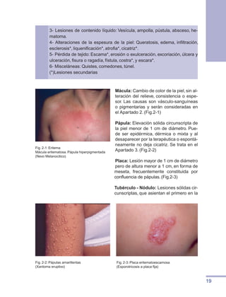 19
Fig. 2-3: Placa eritematoescamosa
(Esporotricosis a placa fija)
Mácula: Cambio de color de la piel, sin al-
teración del relieve, consistencia o espe-
sor. Las causas son vásculo-sanguíneas
o pigmentarias y serán consideradas en
el Apartado 2. (Fig.2-1)
Pápula: Elevación sólida circunscripta de
la piel menor de 1 cm de diámetro. Pue-
de ser epidérmica, dérmica o mixta y al
desaparecer por la terapéutica o espontá-
neamente no deja cicatriz. Se trata en el
Apartado 3. (Fig.2-2)
Placa: Lesión mayor de 1 cm de diámetro
pero de altura menor a 1 cm, en forma de
meseta, frecuentemente constituida por
confluencia de pápulas. (Fig.2-3)
Tubérculo - Nódulo: Lesiones sólidas cir-
cunscriptas, que asientan el primero en la
Fig. 2-1: Eritema
Mácula eritematosa. Pápula hiperpigmentada
(Nevo Melanocitico)
Fig. 2-2: Pápulas amarillentas
(Xantoma eruptivo)
3- Lesiones de contenido líquido: Vesícula, ampolla, pústula, absceso, he-
matoma.
4- Alteraciones de la espesura de la piel: Queratosis, edema, infiltración,
esclerosis*, liquenificación*, atrofia*, cicatriz*.
5- Pérdida de tejido: Escama*, erosión o exulceración, excoriación, úlcera y
ulceración, fisura o ragadía, fístula, costra*, y escara*.
6- Misceláneas: Quistes, comedones, túnel.
(*)Lesiones secundarias
 