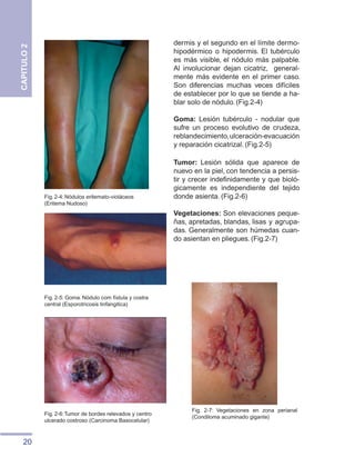 20
CAPITULO
2
dermis y el segundo en el límite dermo-
hipodérmico o hipodermis. El tubérculo
es más visible, el nódulo más palpable.
Al involucionar dejan cicatriz, general-
mente más evidente en el primer caso.
Son diferencias muchas veces difíciles
de establecer por lo que se tiende a ha-
blar solo de nódulo. (Fig.2-4)
Goma: Lesión tubérculo - nodular que
sufre un proceso evolutivo de crudeza,
reblandecimiento,ulceración-evacuación
y reparación cicatrizal. (Fig.2-5)
Tumor: Lesión sólida que aparece de
nuevo en la piel, con tendencia a persis-
tir y crecer indefinidamente y que bioló-
gicamente es independiente del tejido
donde asienta. (Fig.2-6)
Vegetaciones: Son elevaciones peque-
ñas, apretadas, blandas, lisas y agrupa-
das. Generalmente son húmedas cuan-
do asientan en pliegues. (Fig.2-7)
Fig. 2-4: Nódulos eritemato-violáceos
(Eritema Nudoso)
Fig. 2-5: Goma. Nódulo com fístula y costra
central (Esporotricosis linfangitica)
Fig. 2-6:Tumor de bordes relevados y centro
ulcerado costroso (Carcinoma Basocelular)
Fig. 2-7: Vegetaciones en zona perianal
(Condiloma acuminado gigante)
 