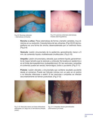 21
Fig. 2-11: Ampollas tensas generalizadas
(Dermatosis Ig A lineal)
Roncha o urtica: Placa edematosa de forma y tamaño variables, muy di-
námica en su evolución. Característica de las urticarias. (Fig.2-8) El dermo-
grafismo es una forma de roncha, desencadenada por un estímulo físico.
(Fig.2-9)
Vesícula: Lesión circunscripta de la epidermis, generalmente menor a 5
mm, de contenido líquido, multitabicada (multilocular). (Fig.2-10)
Ampolla: Lesión circunscripta y elevada,que contiene líquido,generalmen-
te de mayor tamaño que la vesícula y unilocular. Se localiza en epidermis o
en el límite dermoepidérmico (subepidérmico). En las vesículas y ampollas
el contenido puede ser seroso, hemorrágico, turbio o purulento. (Fig.2-11)
Pústula: Lesión elevada y circunscripta que contiene exudado purulento
desde el comienzo. Puede ser folicular (cónica con un pelo en el centro)
o no folicular, infecciosa o estéril. Si las vesículas o ampollas se infectan
secundariamente se llaman pustulosas. (Fig.2-12)
Fig.2-8: Ronchas eritemato
– edematosas (Urticaria)
Fig. 2-9: Lesiones eritemato-edematosas
lineales (Dermografismo)
Fig. 2-10:Vesículas claras con base eritematosa
extendidas a lo largo de un dermatoma (Herpes
zoster)
 