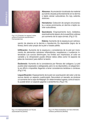 22
CAPITULO
2
Absceso: Acumulación localizada de material
purulento situada profundamente en la dermis
o tejido celular subcutáneo. Es rojo, caliente,
doloroso.
Hematoma: Colección de sangre circunscrip-
ta, a veces prominente, en dermis o tejido ce-
lular subcutáneo.
Queratosis: Engrosamiento duro, inelástico,
eventualmente áspero de la superficie cutánea
por aumento de la capa córnea. (Fig.2-13)
Edema: Aumento de la espesura por extrava-
sación de plasma en la dermis o hipodermis. Es depresible (signo de la
fóvea), tiene color propio de la piel o rosado pálido.
Infiltración: Aumento de la espesura y consistencia de la piel por incre-
mento de elementos celulares inflamatorios, neoplásicos o sustancia in-
tercelular. Los surcos disminuyen, los límites son imprecisos, el color es
variable y la vitropresión puede ofrecer datos útiles como “el aspecto de
jalea de manzana” para definir la lesión.
Esclerosis: Aumento de la consistencia por fibrosis del colágeno. La piel
puede estar espesada o adelgazada, pero no es depresible y el plegamien-
to es difícil o imposible, llegando a tener consistencia lardácea o coriácea.
(Fig.2-14)
Liquenificación: Espesamiento de la piel con acentuación del color y de los
surcos dando un aspecto cuadriculado. Secundario al rascado, se produce
un aumento de la capa de Malpighi.En determinados lugares,como el escro-
to, puede tener un aspecto gigante o cerebriforme. (Fig.2-15)
Fig. 2-13: Hiperqueratosis con fisuras
(Queratodermia plantar)
Fig. 2-12: Pústulas “en reguero” sobre
eritema (Pustulosis exantemática –
Farmacodermia)
Fig. 2-14: Placa esclerótica con halo eritemato-
violáceo perilesional (Morfea)
 