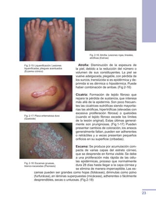 23
Atrofia: Disminución de la espesura de
la piel, debido a la reducción del número o
volumen de sus constituyentes. La piel se
vuelve adelgazada, plegable, con pérdida de
los surcos, translúcida si es epidérmica y de-
primida si es dérmica o hipodérmica. Puede
haber combinación de ambas. (Fig.2-16)
Cicatriz: Formación de tejido fibroso que
repara la pérdida de sustancia, que interesa
más allá de la epidermis. Son poco frecuen-
tes las cicatrices eutróficas siendo mayorita-
rias las atróficas, hipertróficas (elevadas con
excesiva proliferación fibrosa) o queloides
(cuando el tejido fibroso excede los límites
de la lesión original). Estas últimas general-
mente son pruriginosas. (Fig.1-17) Pueden
presentar cambios de coloración, los anexos
generalmente faltan, pueden ser adherentes
o retráctiles y a veces presentan pequeños
orificios en su superficie (cribadas).
	
Escama: Se produce por acumulación com-
pacta de varias capas del estrato córneo,
que se desprende en forma visible. Se debe
a una proliferación más rápida de las célu-
las epidérmicas, proceso que normalmente
dura 28 días hasta llegar a la capa córnea y
se elimina de manera imperceptible. Las es-
camas pueden ser grandes como hojas (foliáceas), diminutas como polvo
(furfurácea), en láminas superpuestas (micáceas), adherentes o fácilmente
desprendibles, secas o untuosas. (Fig.2-18)
Fig. 2-16: Atrofia. Lesiones rojas, lineales,
atróficas (Estrías)
Fig. 2-17: Placa eritematosa dura
(Queloide)
Fig. 2-15: Liquenificación. Lesiones
liquenificadas, pliegues acentuados
(Eczema crónico)
Fig. 2-18: Escamas gruesas,
blanco-nacaradas (Psoriasis)
 
