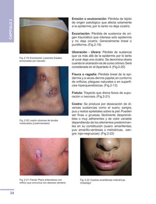 24
CAPITULO
2
Erosión o exulceración: Pérdida de tejido
de origen patológico que afecta solamente
a la epidermis, por lo tanto no deja cicatriz.
Excoriación: Pérdida de sustancia de ori-
gen traumático que interesa solo epidermis
y no deja cicatriz. Generalmente lineal o
puntiforme. (Fig.2-19)
Ulceración - Ulcera: Pérdida de sustancia
que va más allá de la epidermis por lo tanto
al curar deja una cicatriz.Se denomina úlcera
cuando la ulceración es de curso crónico.Será
considerada en el Apartado 4.(Fig.2-20)
Fisura o ragadía: Pérdida lineal de la epi-
dermis y a veces dermis papilar,en contorno
de orificios, pliegues naturales o en superfi-
cies hiperqueratósicas. (Fig.2-13)
Fístula: Trayecto que drena focos de supu-
ración o necrosis. (Fig.2-21)
Costra: Se produce por desecación de di-
versas sustancias como el suero, sangre,
pus y restos epiteliales sobre la piel.Pueden
ser finas o gruesas, fácilmente desprendi-
bles o muy adherentes y de color variable
dependiendo de los elementos predominan-
tes en su constitución (suero: amarillentas,
pus: amarillo-verdosas o melicéricas, san-
gre: rojo-negruzcas). (Fig.2-22)
Fig. 2-19: Excoriación. Lesiones lineales
provocadas por rascado
Fig. 2-20: Lesión ulcerosa de bordes
moldurados (Leishmaniasis)
Fig. 2-21: Fistula. Placa eritematosa con
orificio que comunica con absceso dentario
Fig. 2-22: Costras amarillentas melicéricas
(Impetigo)
 