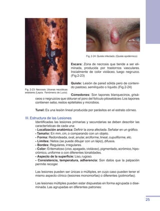 25
Escara: Zona de necrosis que tiende a ser eli-
minada, producida por trastornos vasculares.
Inicialmente de color violáceo, luego negruzco.
(Fig.2-23)
Quiste: Lesión de pared sólida pero de conteni-
do pastoso, semilíquido o líquido. (Fig.2-24)
Comedones: Son tapones blanquecinos, grisá-
ceos o negruzcos que obturan el poro del folículo pilosebáceo.Los tapones
contienen sebo, restos epiteliales y microbios.
Tunel: Es una lesión lineal producida por parásitos en el estrato córneo.
III. Estructura de las Lesiones
Identificadas las lesiones primarias y secundarias se deben describir las
características de cada una:
- Localización anatómica: Definir la zona afectada. Señalar en un gráfico.
- Tamaño: En mm, cm, o comparando con un objeto.
- Forma: Redondeada, oval, anular, arciforme, lineal, cupuliforme, etc.
- Límites: Netos (se puede dibujar con un lápiz), difusos.
- Bordes: Regulares, irregulares.
- Color: Eritematoso (vivo,apagado,violáceo),pigmentado,acrómico,hipo-
crómico, uniforme o con diferentes tonalidades.
- Aspecto de la superficie: Liso, rugoso.
- Consistencia, temperatura, adherencia: Son datos que la palpación
permite recoger.
Las lesiones pueden ser únicas o múltiples, en cuyo caso pueden tener el
mismo aspecto clínico (lesiones monomorfas) o diferentes (polimorfas).
Las lesiones múltiples pueden estar dispuestas en forma agrupada o dise-
minada. Las agrupadas en diferentes patrones:
Fig. 2-23: Necrosis. Ulceras necróticas
estelares (Lepra. Fenómeno de Lucio)
Fig. 2-24: Quiste infectado. (Quiste epidérmico)
 