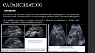 CA PANCREATICO
• Ecografía:
•Los tumores de páncreas se aprecian como masas sólidas e hipoecogénicas, mal delimitadas.
Presentan pobre vascularización en el estudio Doppler y escaso realce con contraste ecográfico.
•Si se localizan en la cabeza, producen obstrucción y dilatación secundaria de la vía biliar y del
conducto pancreático(“signo de doble conducto”).
 
