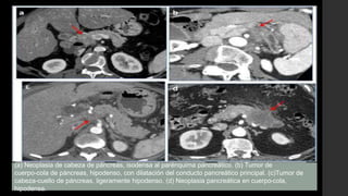Localización de la
lesión:
•Cabeza-proceso
uncinado (65%)
•Cuerpo (20-25%)
•Cola (10-20%)
Tamaño del tumor:
•Permite
estadificar y
valorar la
respuesta tras el
tratamiento en el
seguimiento
Densidad tras la
administración de
contraste iv:
• Hipodensa: la
mayoría de los
tumores.
• Isodensa (10%): es
más frecuente que
los tumores sean
isodensos al resto
del parénquima
pancreático cuando
su tamaño ≤2 cm.
(a) Neoplasia de cabeza de páncreas, isodensa al parénquima pancreático. (b) Tumor de
cuerpo-cola de páncreas, hipodenso, con dilatación del conducto pancreático principal. (c)Tumor de
cabeza-cuello de páncreas, ligeramente hipodenso. (d) Neoplasia pancreática en cuerpo-cola,
hipodensa.
 