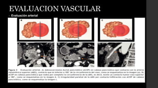 EVALUACION VASCULAR
• Evaluación arterial
 