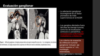 Evaluación ganglionar
• La afectación ganglionar
locorregional es un factor
pronóstico de mala
supervivencia en el ACDP.
• Los ganglios afectados fuera
del área de drenaje tumoral,
como los de localización
aortocava o paraaórtica, se
considerarán enfermedad
metastásica a distancia
Los criterios de sospecha
de infiltración tumoral
ganglionar incluyen: eje
menor superior a 1 cm,
morfología
redondeada,
heterogeneidad o necrosis
 