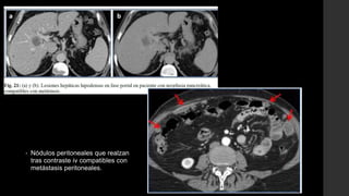 • Nódulos peritoneales que realzan
tras contraste iv compatibles con
metástasis peritoneales.
 