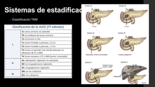 Sistemas de estadificación
• Estadificación TNM
 