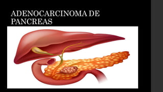 ADENOCARCINOMA DE
PANCREAS
 