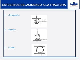 1. Compresión.
2. Impacto.
3. Cizalle.
ESFUERZOS RELACIONADO A LA FRACTURA
 
