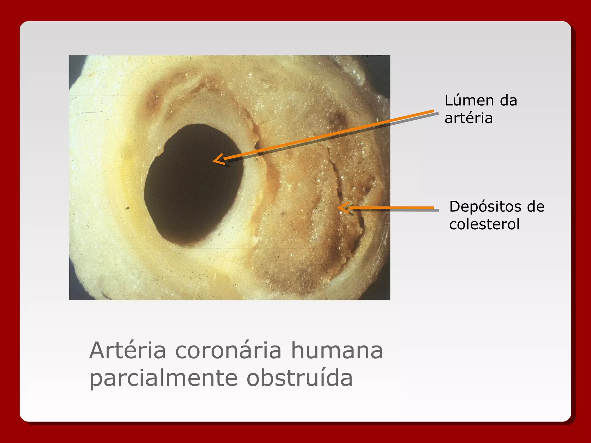 Artéria coronária humana
parcialmente obstruída
Lúmen da
artéria
Depósitos de
colesterol
 