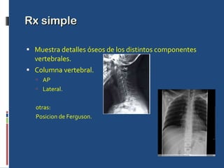 Rx simple Muestra detalles óseos de los distintos componentes vertebrales. Columna vertebral. AP  Lateral. otras: Posicion de Ferguson. 