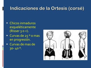 Indicaciones de la Ortesis (corsé) Chicos inmaduros esqueléticamente (Risser 3 o <). Curvas de 25 º o mas en progresión. Curvas de mas de  30- 40 º. 