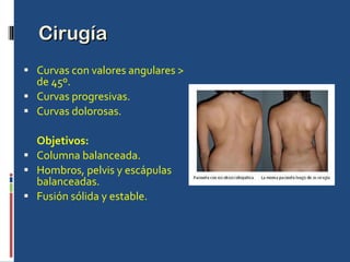 Cirugía Curvas con valores angulares > de 45º. Curvas progresivas. Curvas dolorosas. Objetivos: Columna balanceada. Hombros, pelvis y escápulas balanceadas. Fusión sólida y estable. 