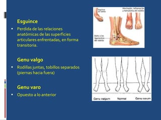 Esguince Perdida de las relaciones anatómicas de las superficies articulares enfrentadas, en forma transitoria. Genu valgo Rodillas juntas, tobillos separados (piernas hacia fuera) Genu varo Opuesto a lo anterior 