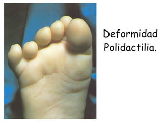 Deformidad Polidactilia. 
