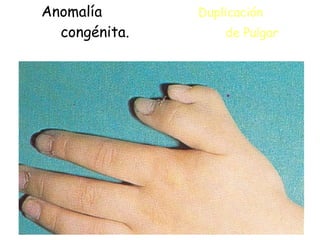 Anomalía  Duplicación     congénita.  de Pulgar 