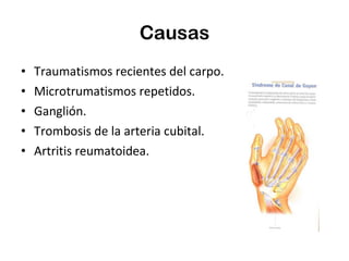 Causas Traumatismos recientes del carpo. Microtrumatismos repetidos. Ganglión. Trombosis de la arteria cubital. Artritis reumatoidea. 