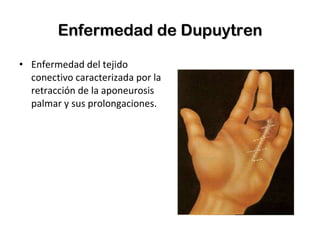 Enfermedad de Dupuytren Enfermedad del tejido conectivo caracterizada por la retracción de la aponeurosis palmar y sus prolongaciones. 