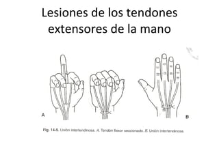 Lesiones de los tendones extensores de la mano 