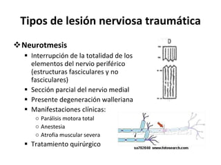 Tipos de lesión nerviosa traumática Neurotmesis Interrupción de la totalidad de los elementos del nervio periférico (estructuras fasciculares y no fasciculares) Sección parcial del nervio medial Presente degeneración walleriana Manifestaciones clínicas: Parálisis motora total Anestesia Atrofia muscular severa Tratamiento quirúrgico 
