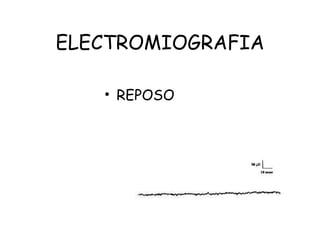 ELECTROMIOGRAFIA REPOSO 