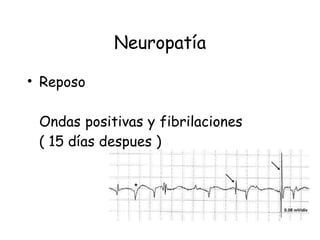 Neuropatía Reposo Ondas positivas y fibrilaciones  ( 15 días despues ) 