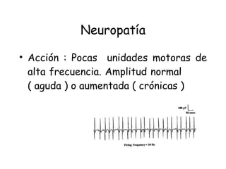 Neuropatía Acción : Pocas  unidades motoras de alta frecuencia. Amplitud normal  ( aguda ) o aumentada ( crónicas ) 