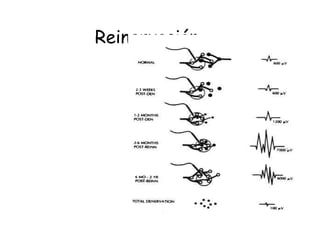 Reinervación 