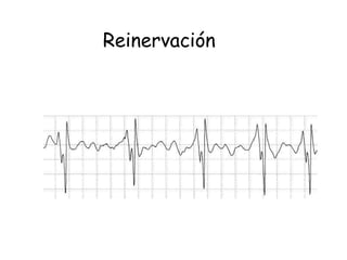 Reinervación 