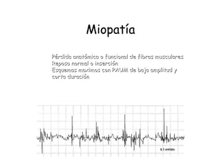 Miopatía Pérdida anatómica o funcional de fibras musculares Reposo normal o inserción Esquemas maximos con PAUM de baja amplitud y  corta duración 
