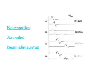 Neuropatías Axonales Desmielinizantes 