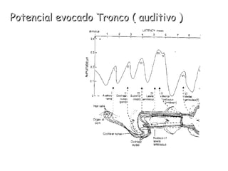 Potencial evocado Tronco ( auditivo ) 