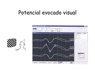Potencial evocado visual 