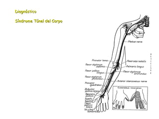 Diagnóstico Síndrome Túnel del Carpo 