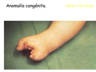 Anomalía congénita.  Mano hendida 