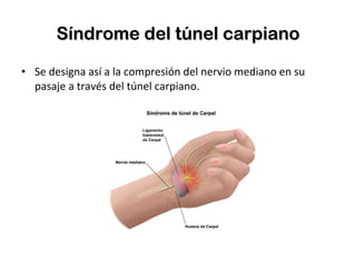 Síndrome del túnel carpiano Se designa así a la compresión del nervio mediano en su pasaje a través del túnel carpiano. 