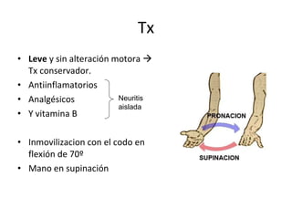 Tx Leve  y sin alteración motora    Tx conservador. Antiinflamatorios Analgésicos Y vitamina B Inmovilizacion con el codo en flexión de 70º Mano en supinación Neuritis  aislada 
