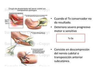 Cuando el Tx conservador no da resultado. Deterioro severo progresivo motor o sensitivo Consiste en descompresión del nervio cubital o transposición anterior subcutánea. Tx Qx 