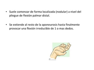 Suele comenzar de forma localizada (nodular) a nivel del pliegue de flexión palmar distal. Se extiende al resto de la aponeurosis hasta finalmente provocar una flexión irreducible de 1 o mas dedos. 