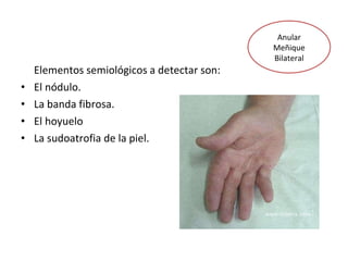 Elementos semiológicos a detectar son: El nódulo. La banda fibrosa. El hoyuelo La sudoatrofia de la piel. Anular Meñique Bilateral 