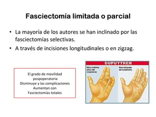 Fasciectomía limitada o parcial La mayoría de los autores se han inclinado por las fasciectomías selectivas. A través de incisiones longitudinales o en zigzag. El grado de movilidad pospoperatoria Disminuye y las complicaciones Aumentan con Fasciectomías totales 