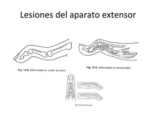 Lesiones del aparato extensor 