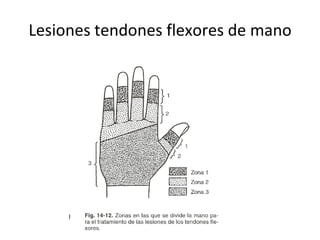 Lesiones tendones flexores de mano 