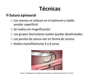 Técnicas Sutura epineural Las suturas se colocan en el epineuro y tejido areolar superficial Se realiza sin magnificación Los grupos fasciculares suelen quedar desalineados Los puntos de sutura son en forma de corona Nailon monofilamento 5 o 6 ceros 