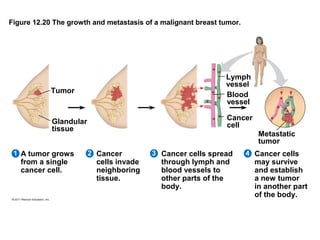 Figure 12.20 The growth and metastasis of a malignant breast tumor.

Tumor

Lymph
vessel
Blood
vessel

Glandular
tissue

Cancer
cell

1 A tumor grows

from a single
cancer cell.

Metastatic
tumor
2 Cancer

cells invade
neighboring
tissue.

3 Cancer cells spread

through lymph and
blood vessels to
other parts of the
body.

4 Cancer cells

may survive
and establish
a new tumor
in another part
of the body.

 